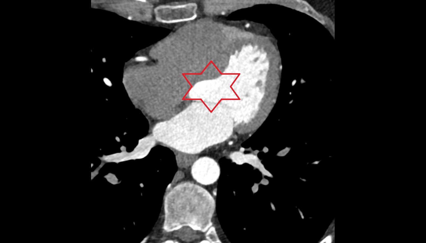 Heart CT AXIAL image -img-00000-00000