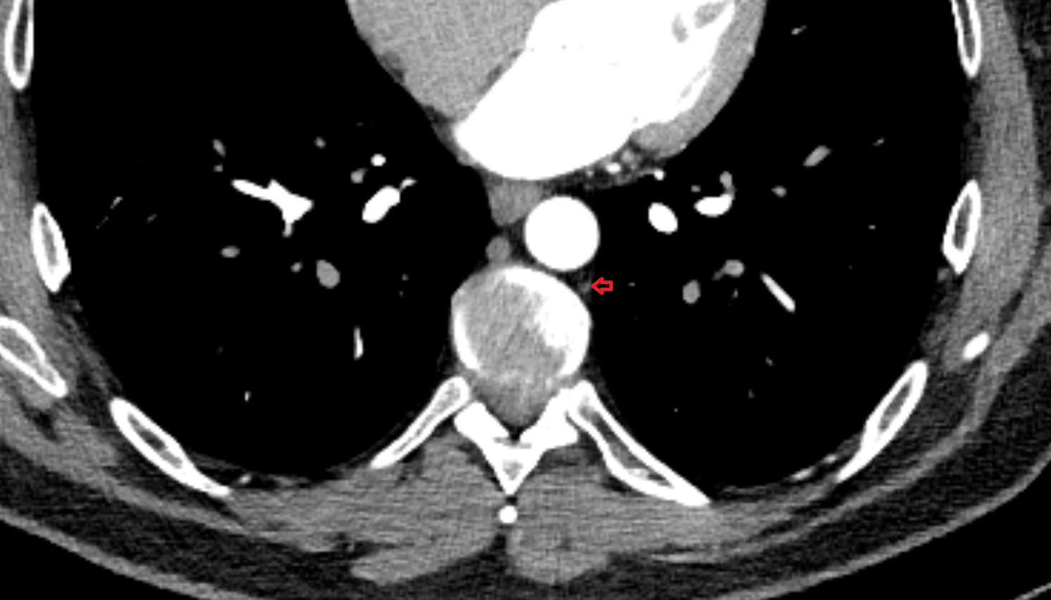 Hemiazygos vein  anatomy CT  AXIAL image -img-00000-00000