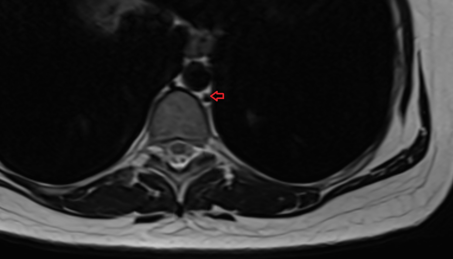 Hemiazygos vein  anatomy  MRI  AXIAL image -img-00000-00000