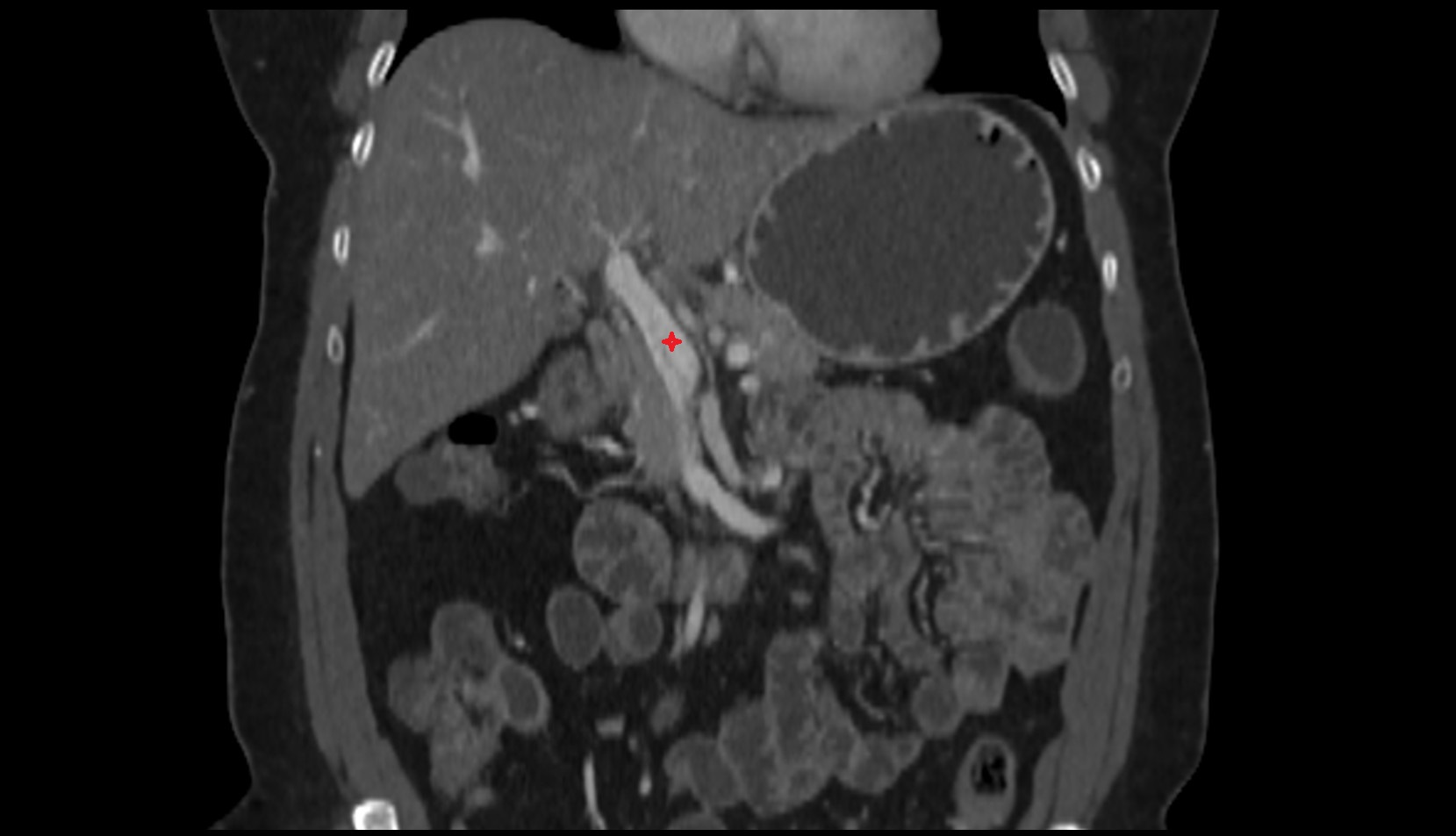 Hepatic portal vein CORONAL CT IMAGE