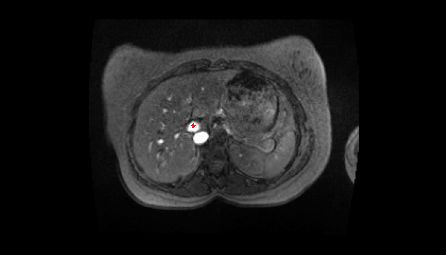 Hepatic portal vein CT axial  image-img-00000-00000