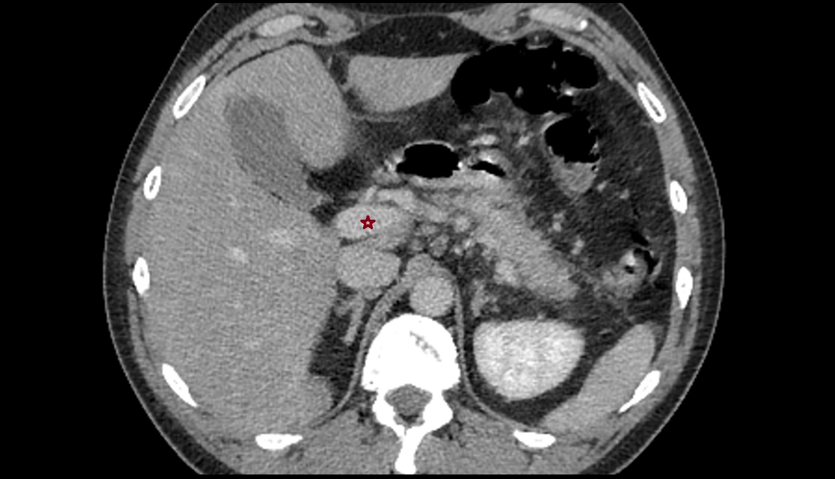 Hepatic portal vein MRI AXIAL IMAGE