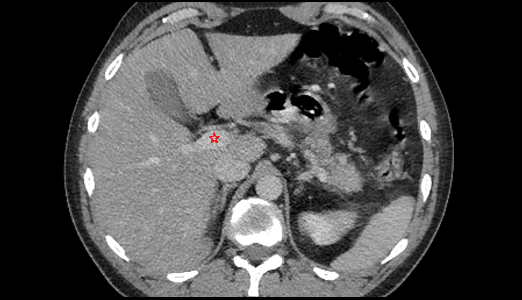 Hepatic portal vein MRI AXIAL IMAGE 1