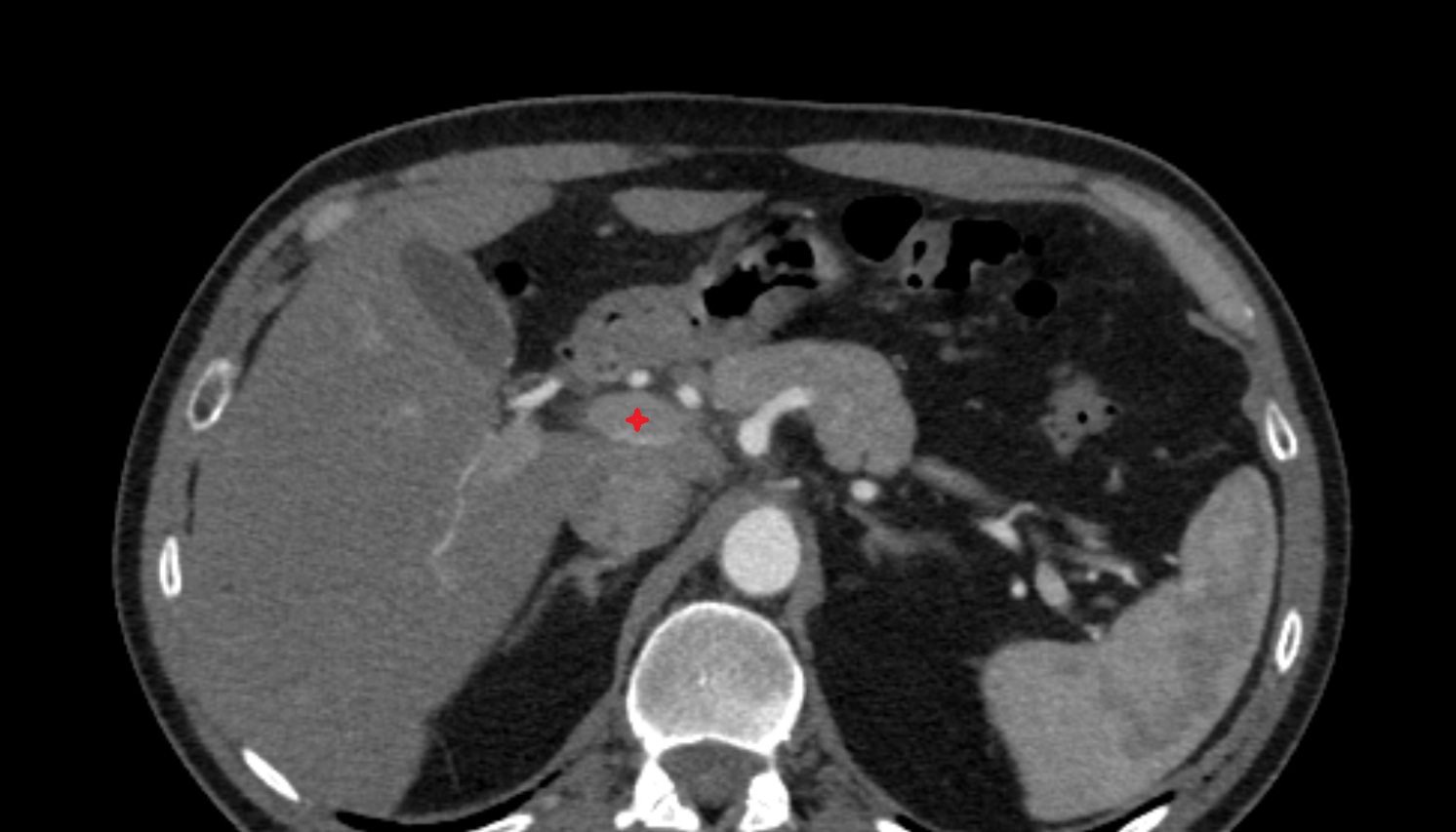 Hepatic portal vein   anatomy CT axial  image -img-00000-00000