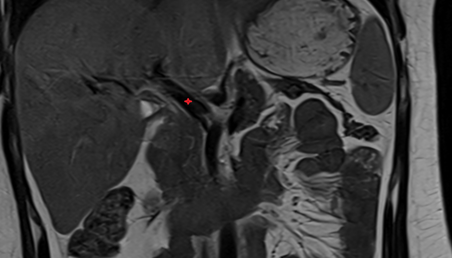 Hepatic portal vein  anatomy MRI  CORONAL image -img-00000-00000