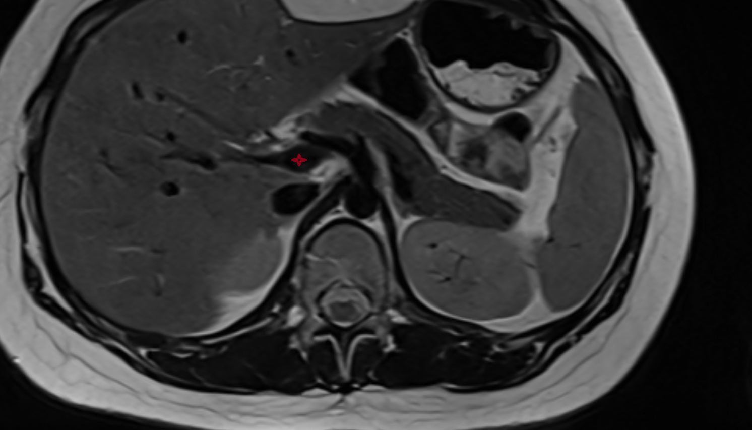 Hepatic portal vein  anatomy MRI  axial  image -img-00000-00000