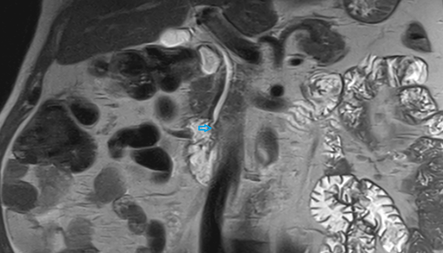 Hepatopancreatic ampulla (ampulla of Vater)  mri coronal  anatomy image-img-00000-00000