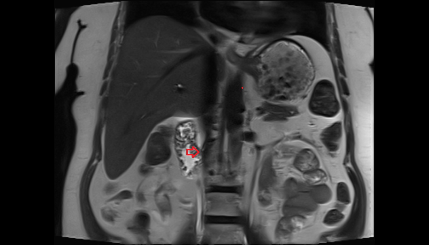 Hepatopancreatic ampulla (ampulla of Vater)  mri coronal  anatomy image-img-00000-00000_00001
