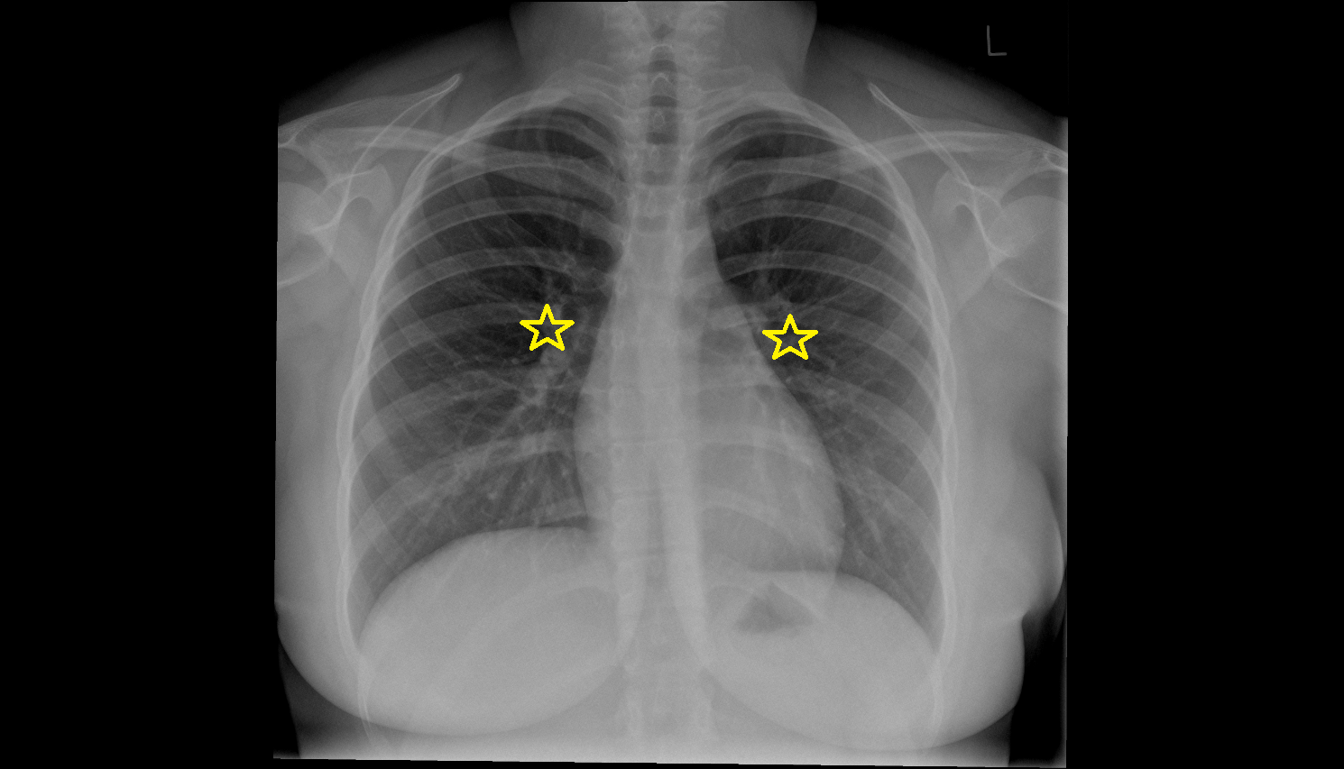 Hilum of lung X RAY Anatomy, Location and Imaging Appearance CT anatomy image -img-00000-00000