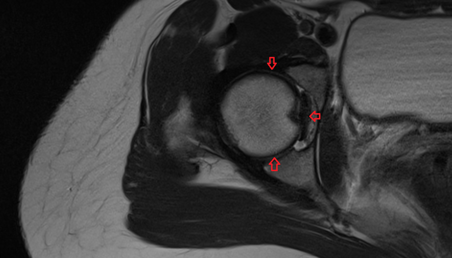 Hip Joint  axial cross sectional anatomy 3T MRI AI enhanced  radiology  anatomy image-img-00000-00000