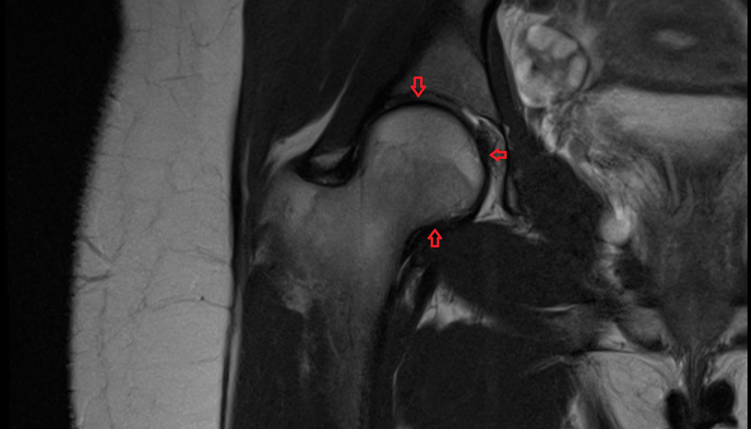 Hip Joint  coronal cross sectional anatomy 3T MRI AI enhanced  radiology  anatomy image-img-00000-00000