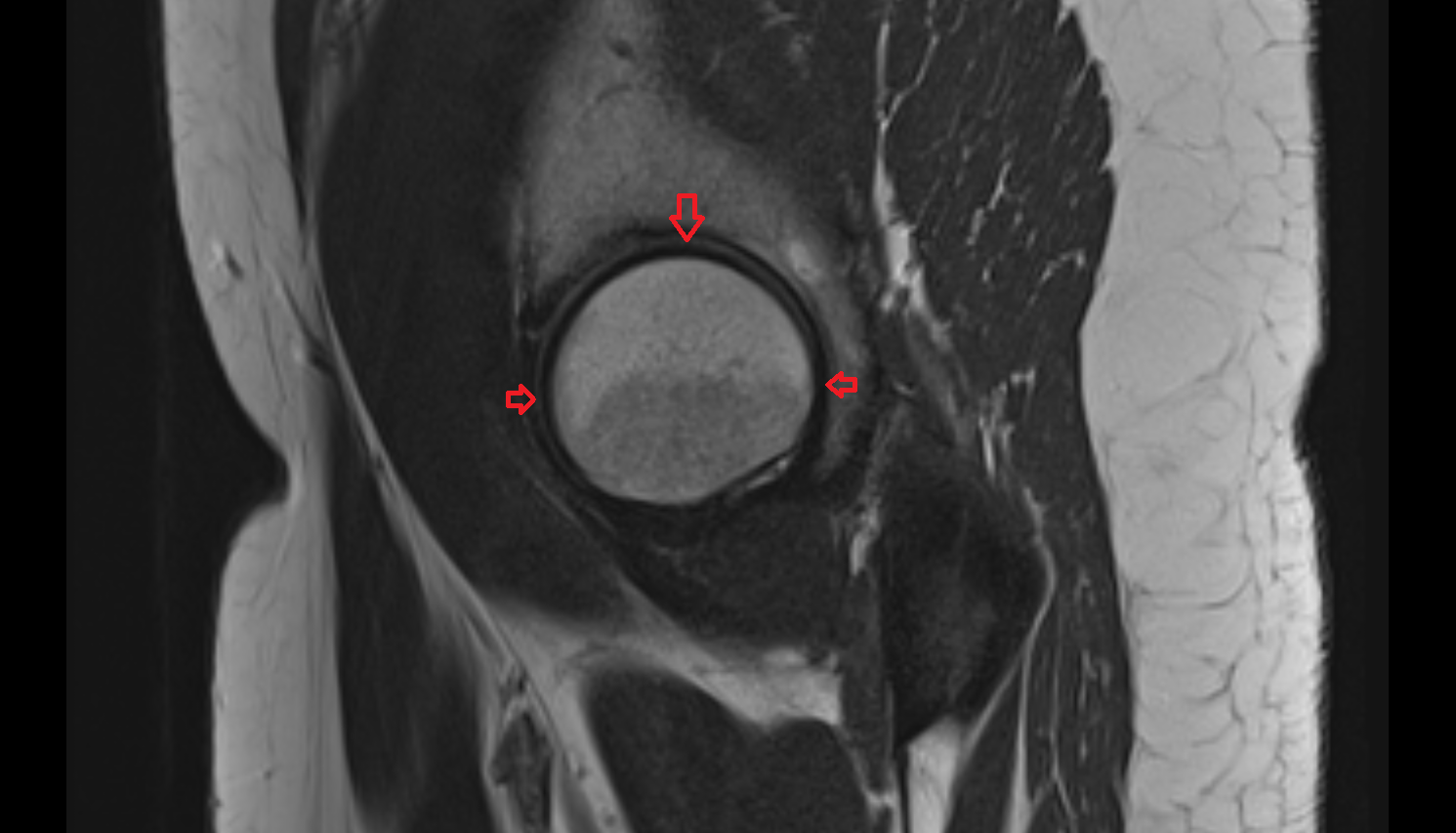 Hip Joint  sagittal cross sectional anatomy 3T MRI AI enhanced  radiology  anatomy image-img-00000-00000