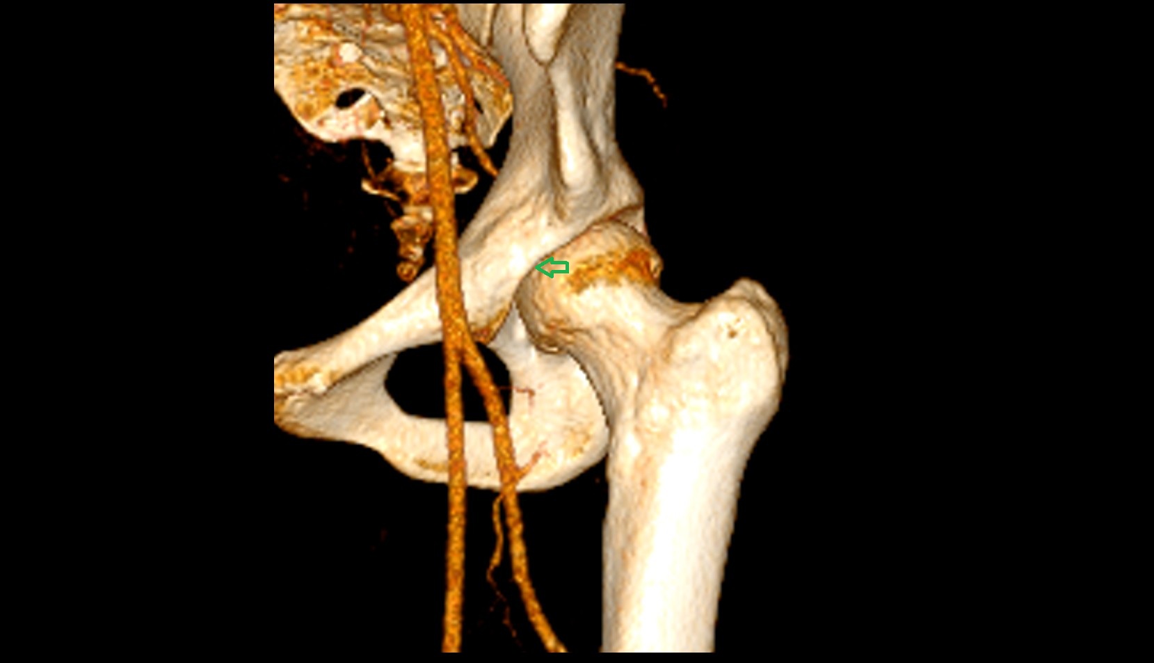 Hip joint anatomy 3d ct image