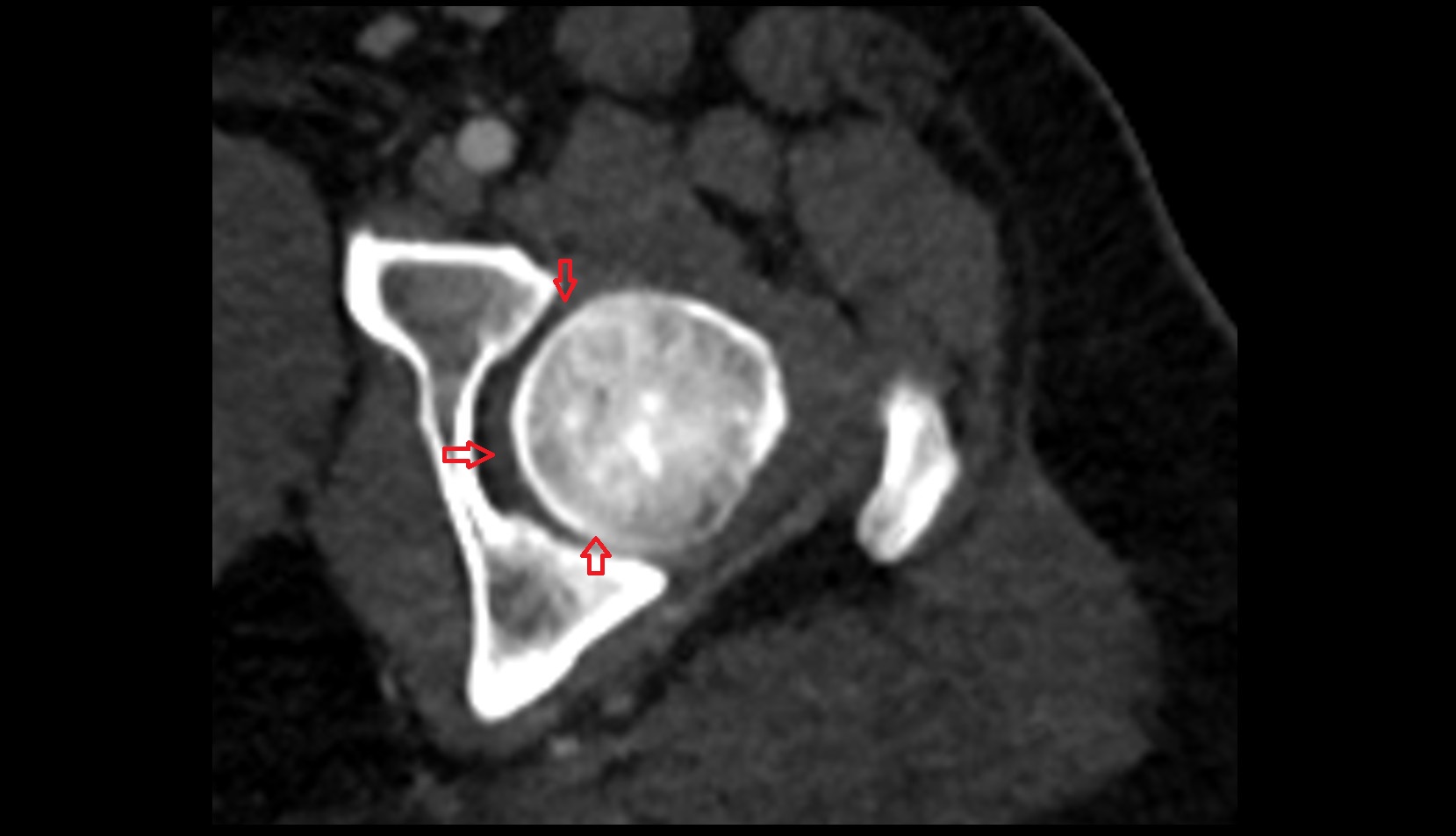 Hip joint anatomy ct axial