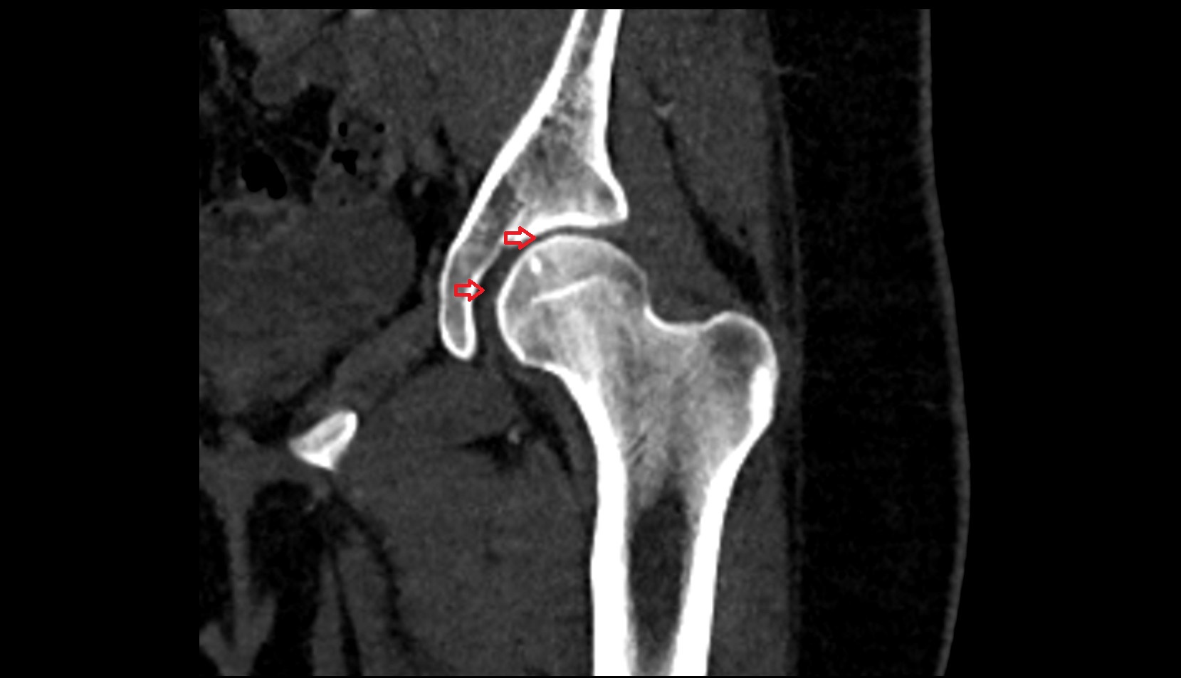 Hip joint anatomy ct coronal image