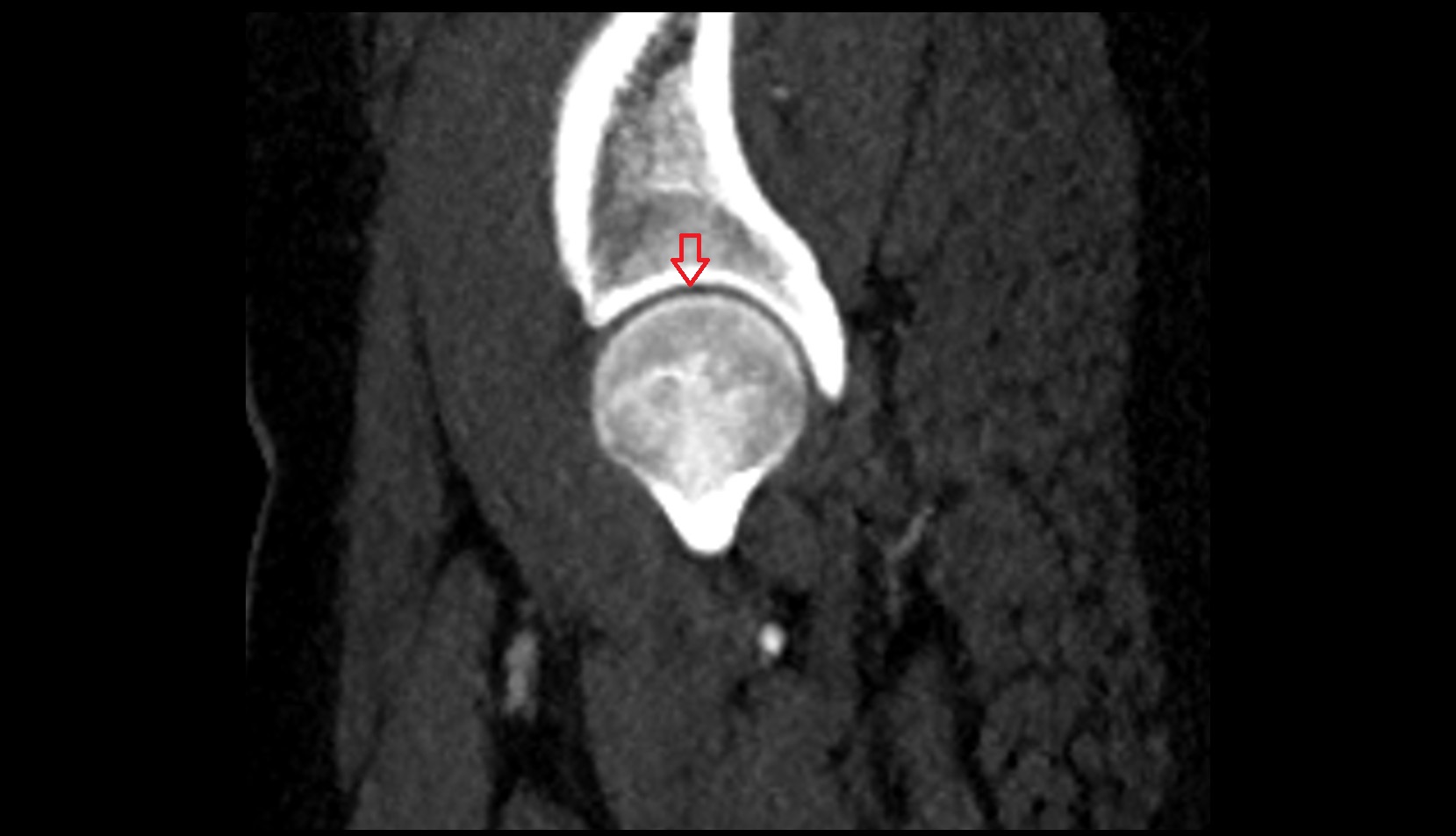 Hip joint anatomy ct sagittal