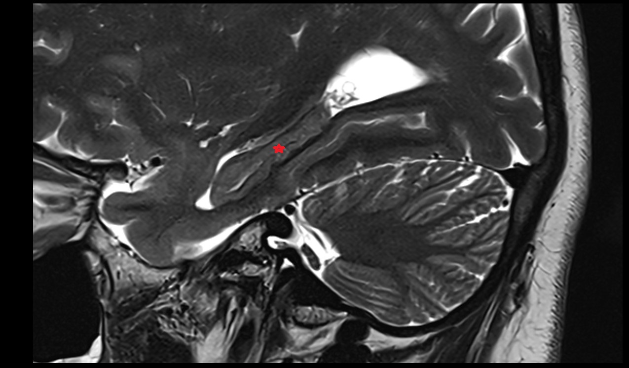 Hippocampal body mri 3t sagittal image