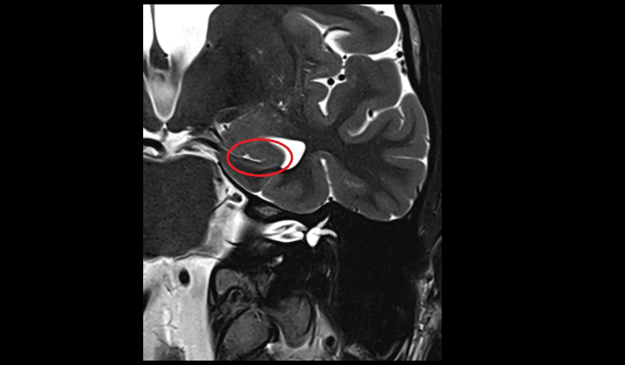 Hippocampal head mri 3t coronal image