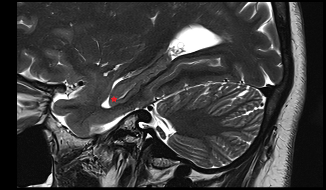 Hippocampal head mri 3t sagittal image