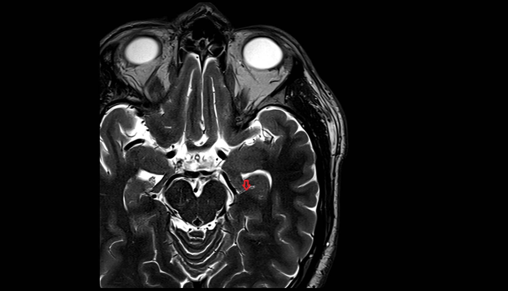 Hippocampal sulcus MRI 3T axial image