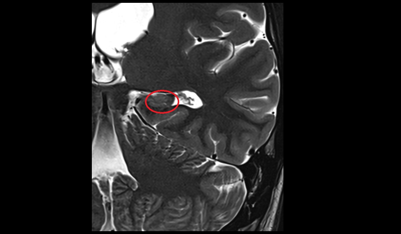 Hippocampal tail mri 3t coronal image