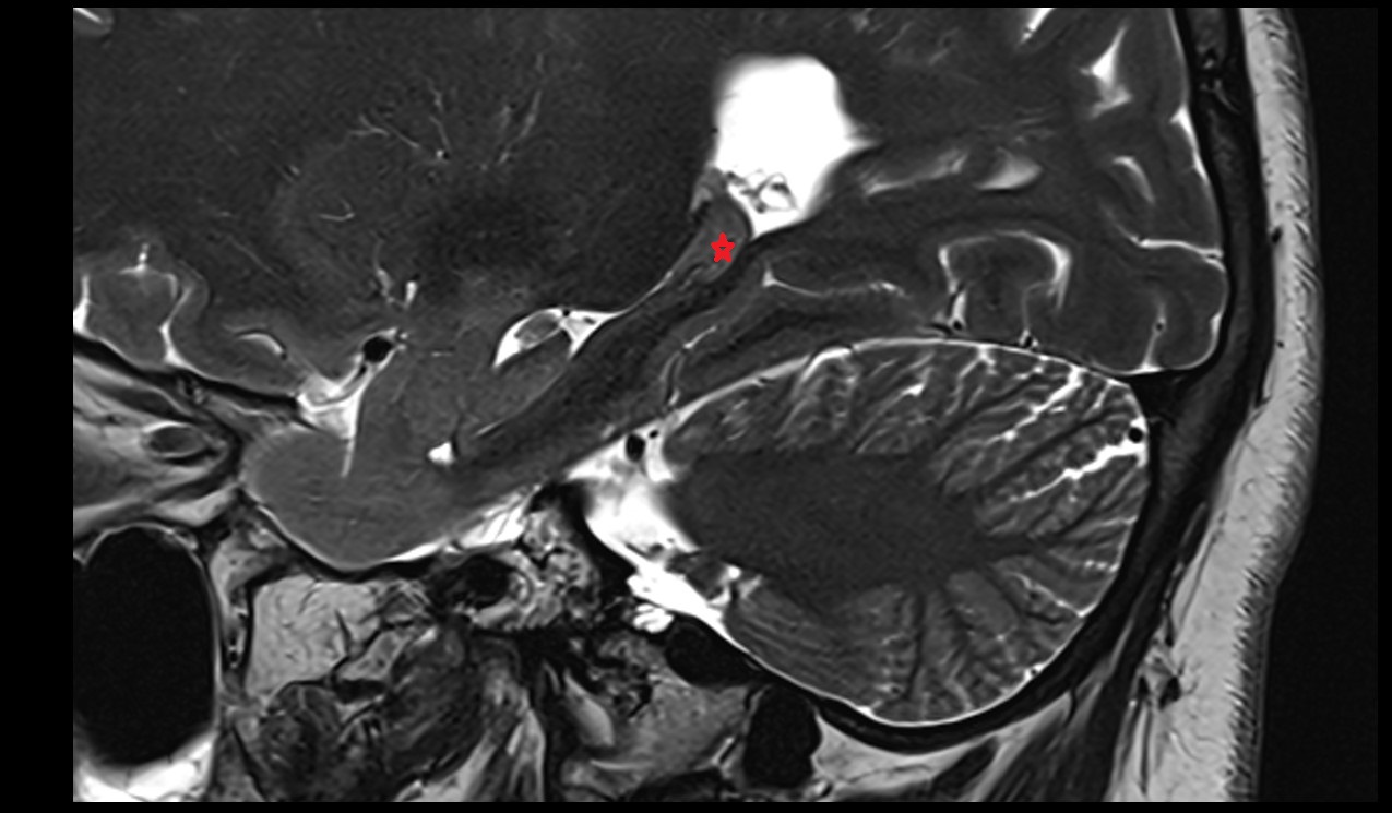 Hippocampal tail mri 3t sagittal image