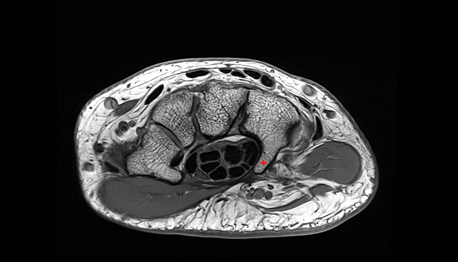 Hook of hamate bone axial cross sectional anatomy 3T MRI AI enhanced radiology image-img-00000-00000