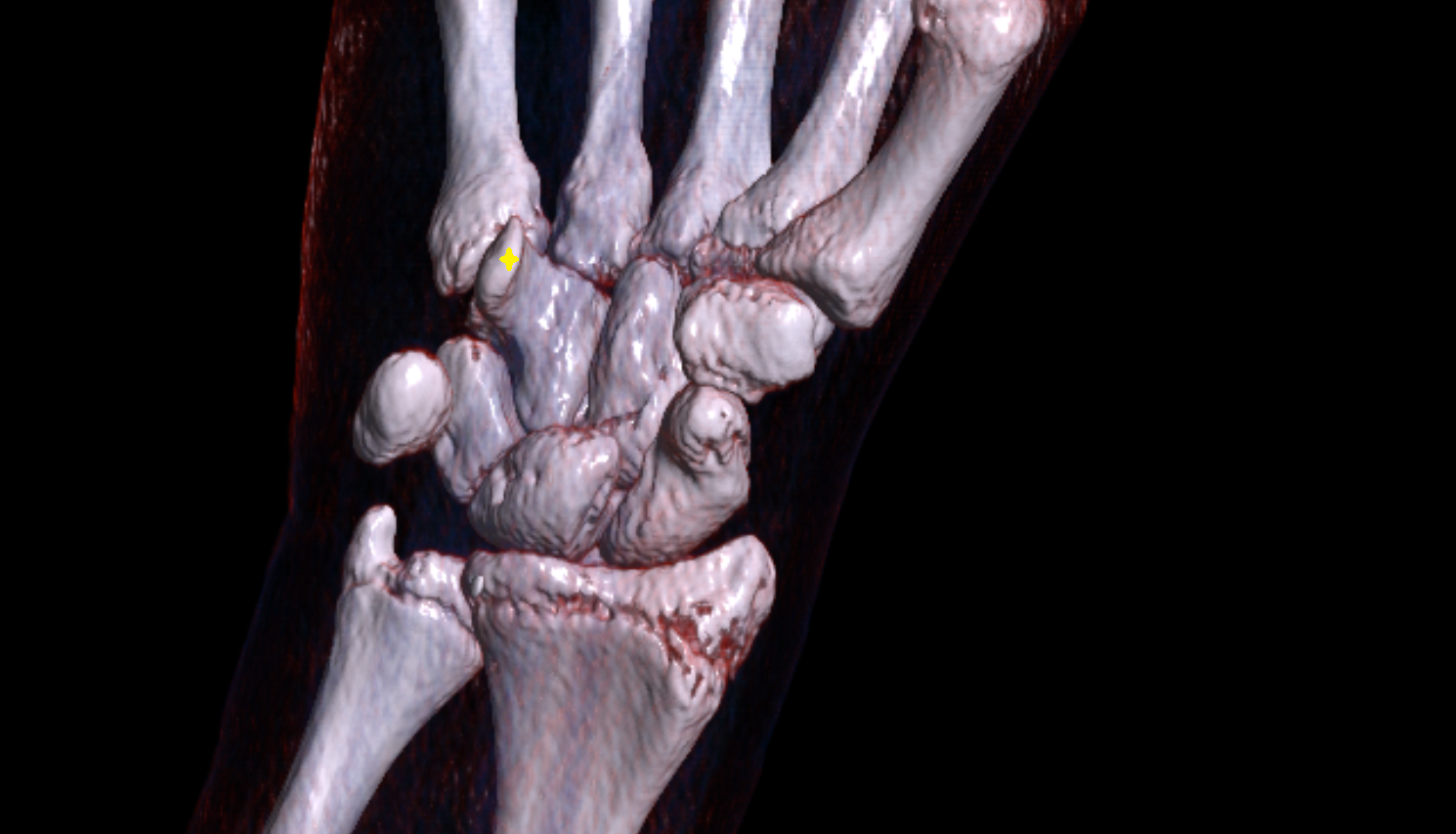 Hook of hamate bone bone CT 3D VRT image -img-00000-00000