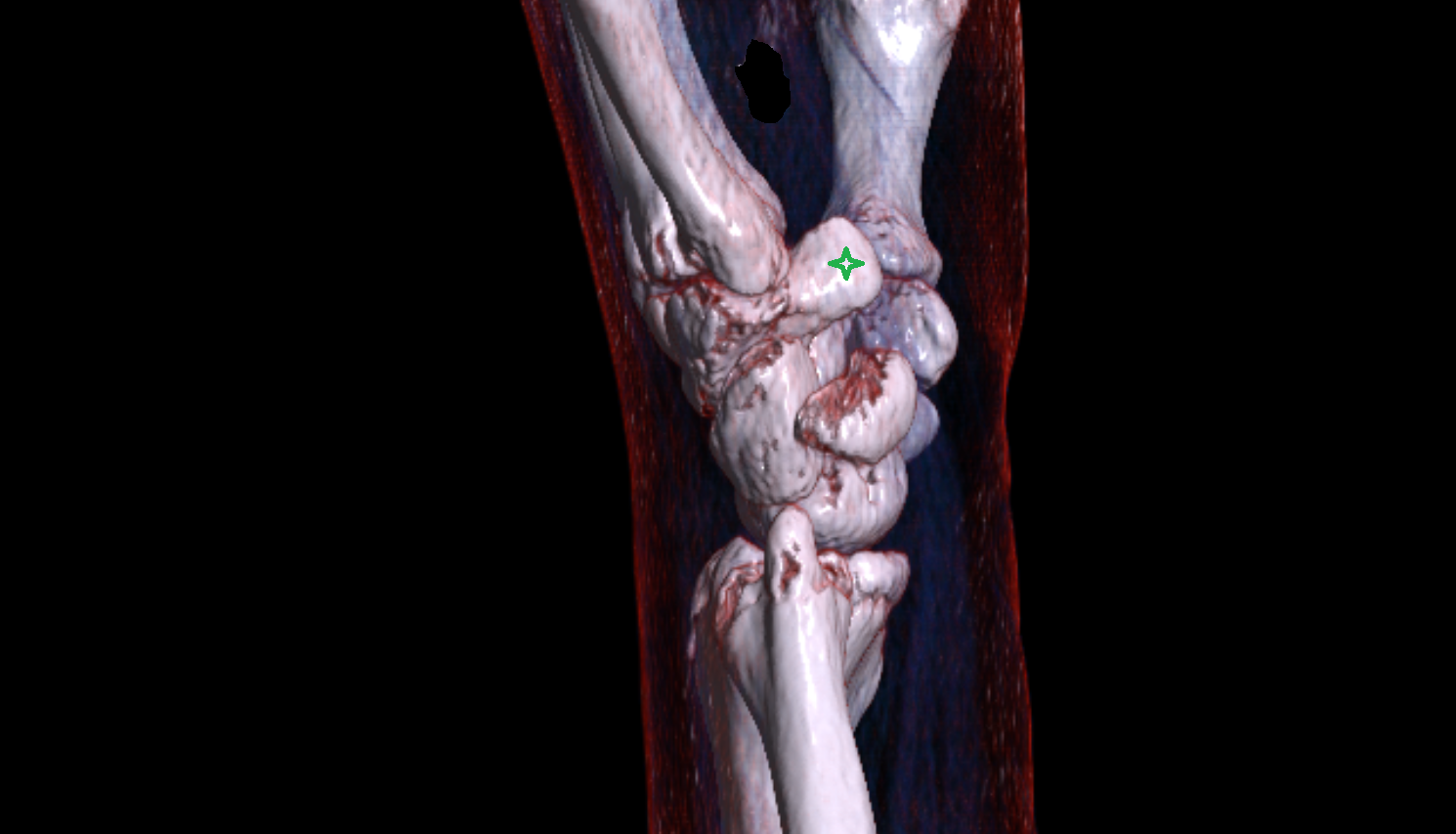 Hook of hamate bone bone CT 3D VRT image -img-00000-00000_00001