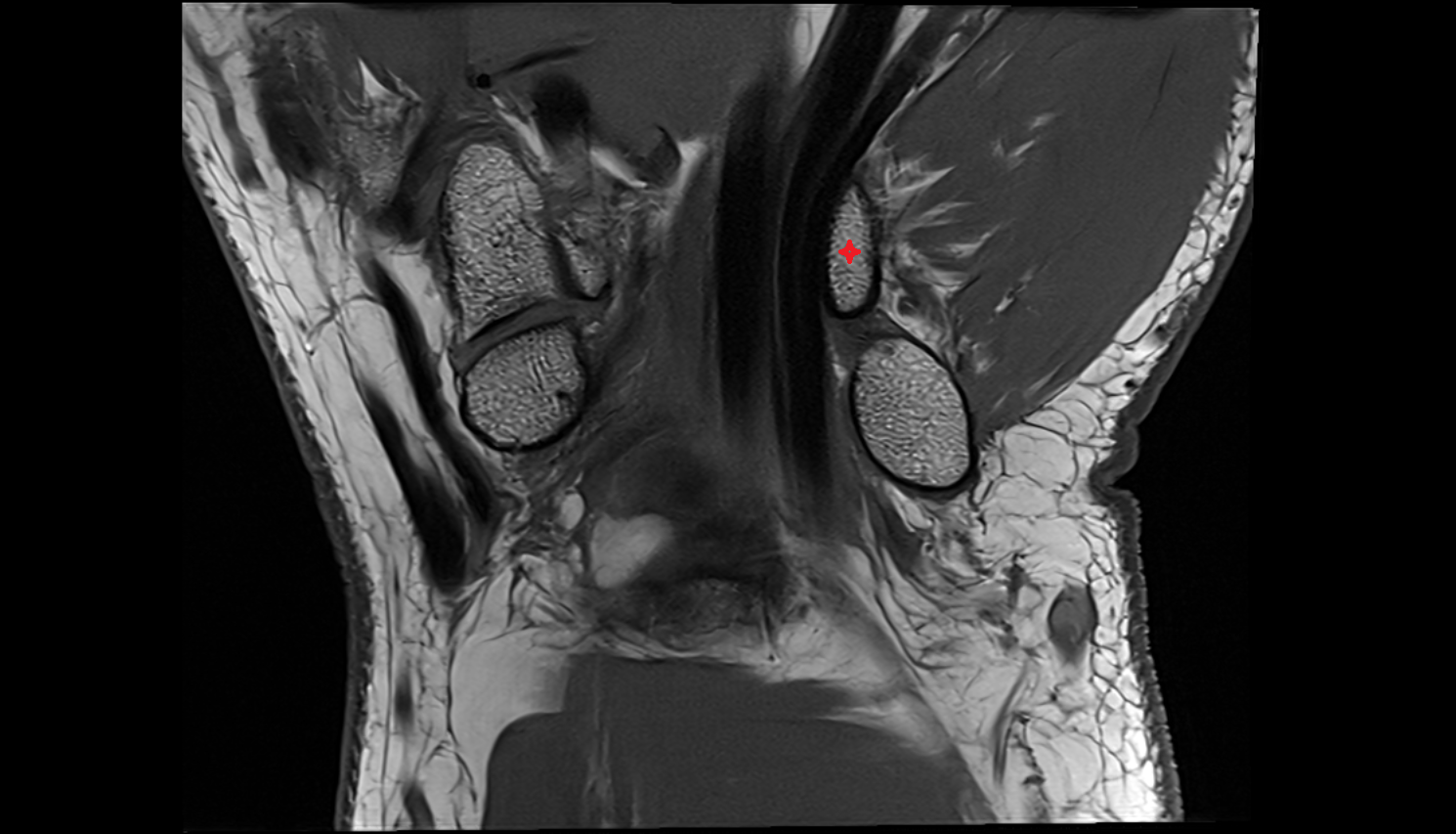 Hook of hamate bone coronal cross sectional anatomy 3T MRI AI enhanced radiology image-img-00000-00000