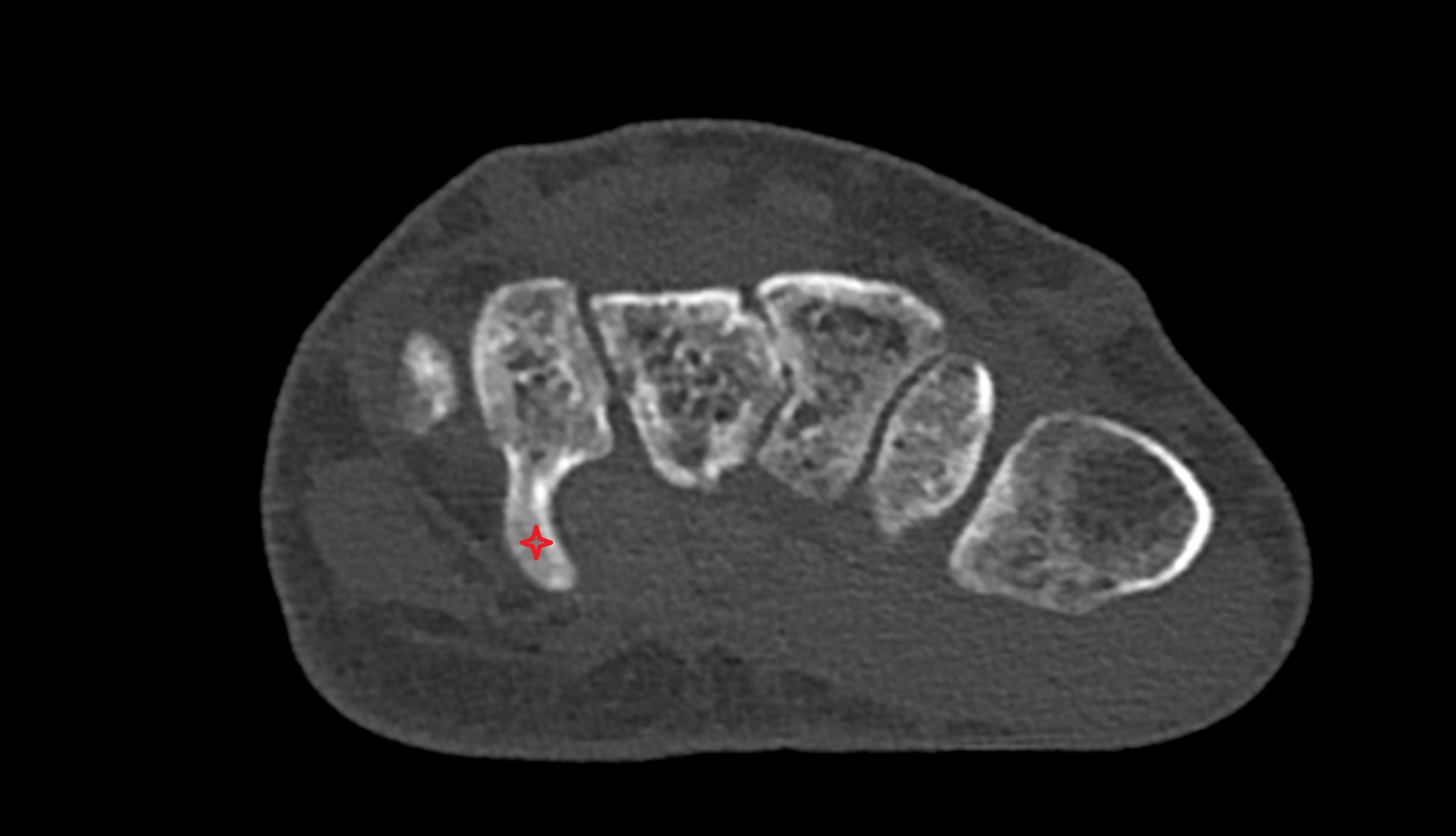 Hook of hamate bone ct axial image