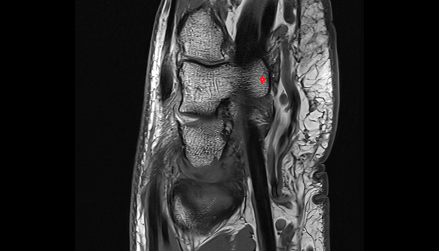 Hook of hamate  bone sag cross sectional anatomy 3T MRI AI enhanced radiology image-img-00000-00000