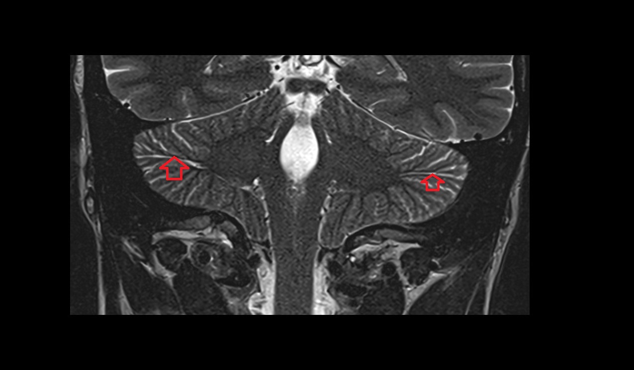 Horizontal fissure MRI 3T coronal  image