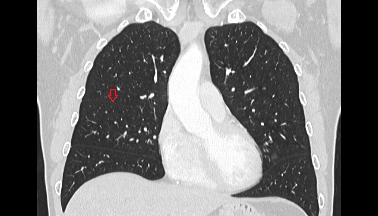 Horizontal fissure of right lung  anatomy  CT coronal  image -img-00000-00000