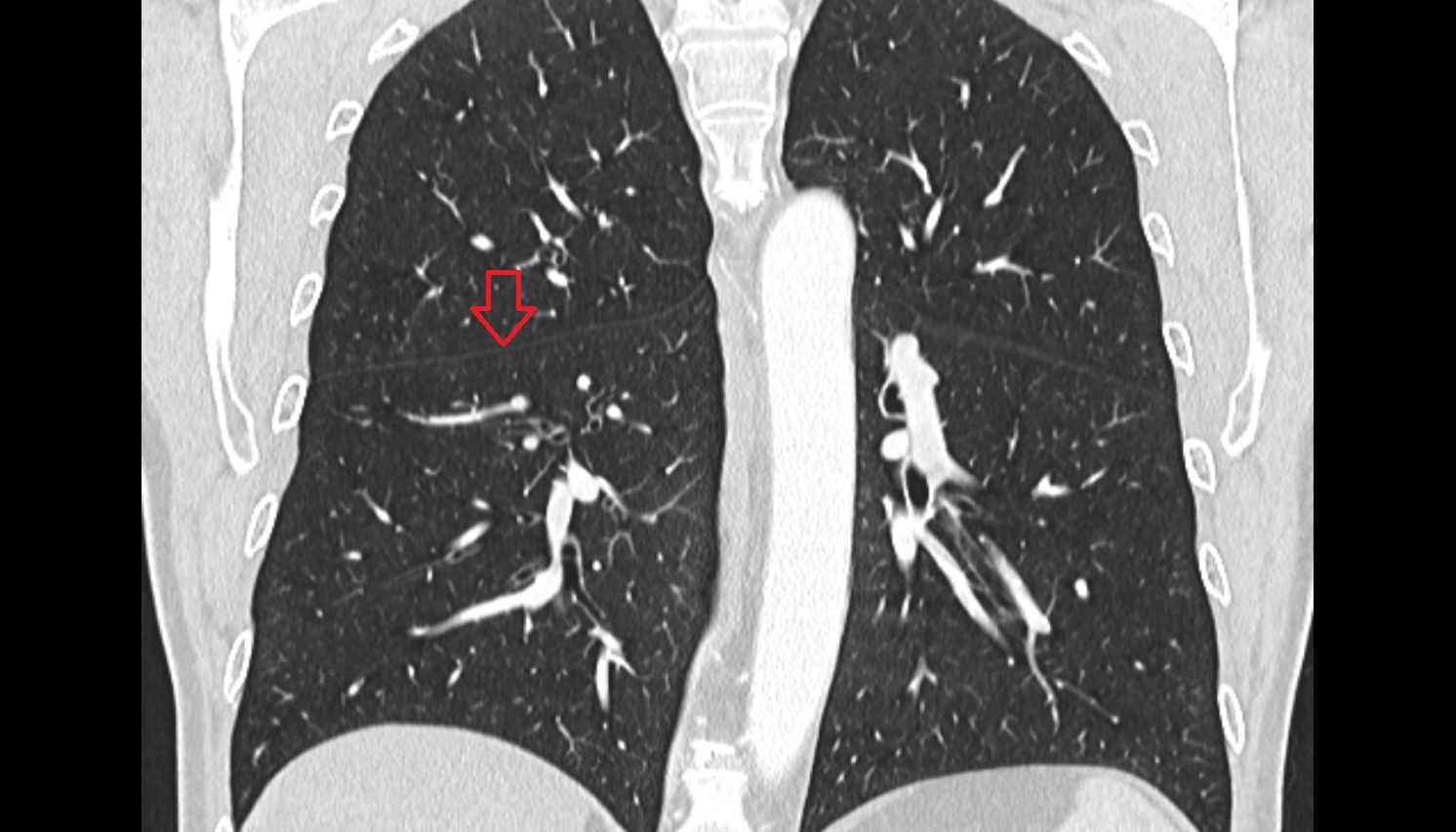 Horizontal fissure of right lung  anatomy  CT coronal  image -img-00000-00000_00001
