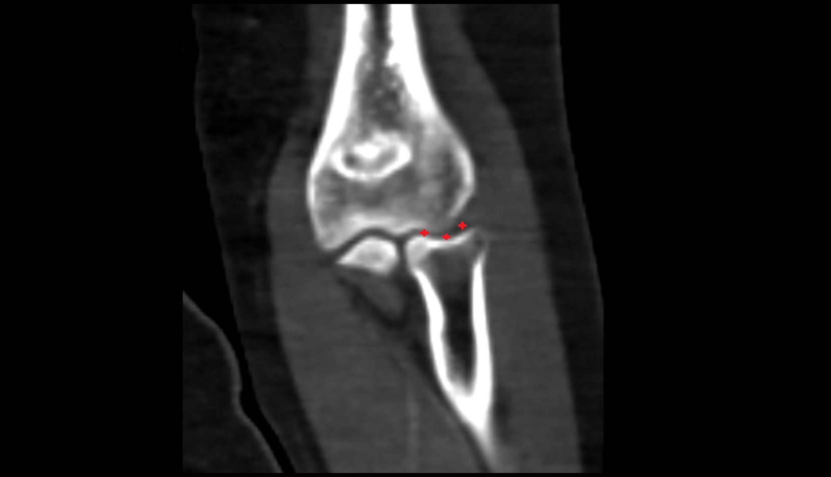 Humeroradial Joint ct image