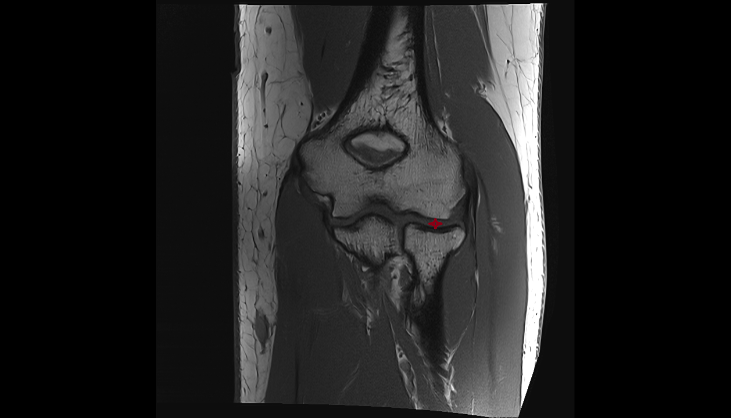 Humeroradial joint coronal  cross sectional anatomy 3T MRI AI enhanced radiology image -img-00000-00000