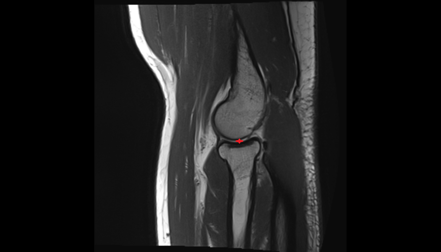 Humeroradial joint sag  cross sectional anatomy 3T MRI AI enhanced radiology image -img-00000-00000