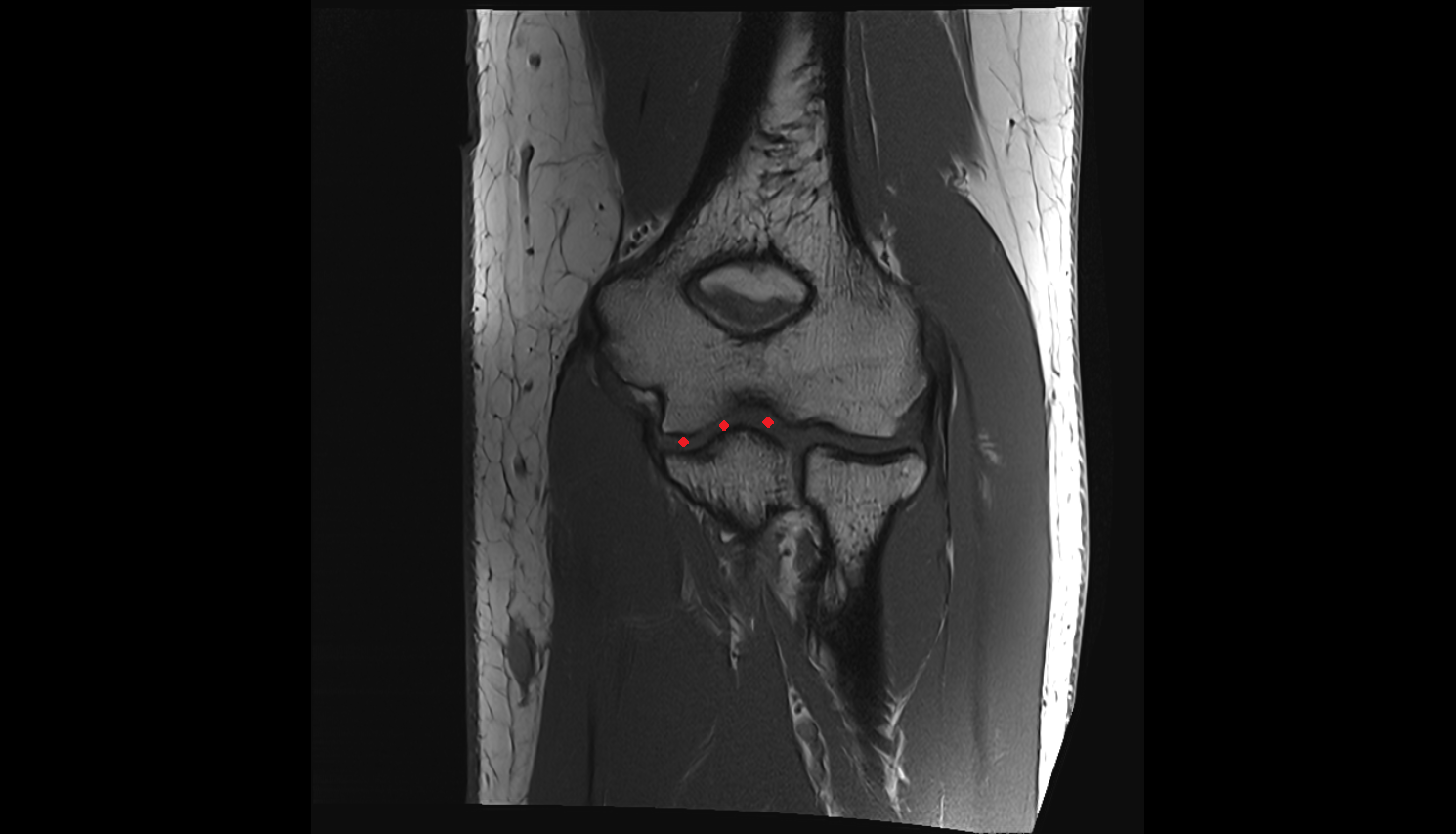 Humeroulnar joint coronal  cross sectional anatomy 3T MRI AI enhanced radiology image -img-00000-00000