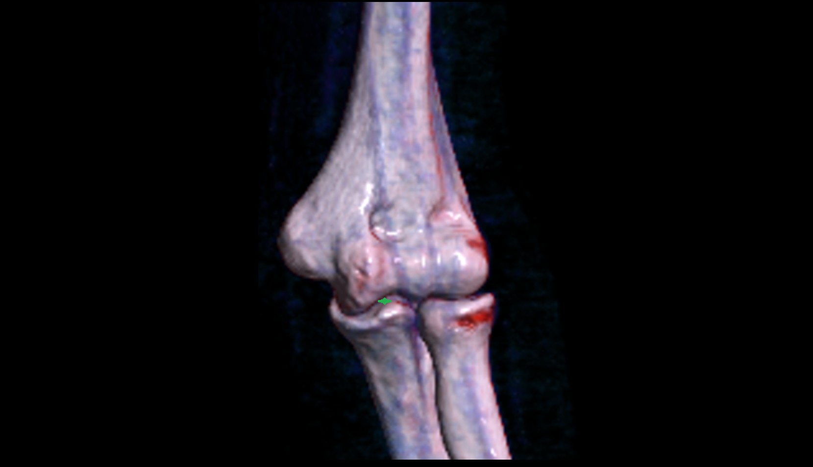 Humeroulnar joint ct 3d vrt image