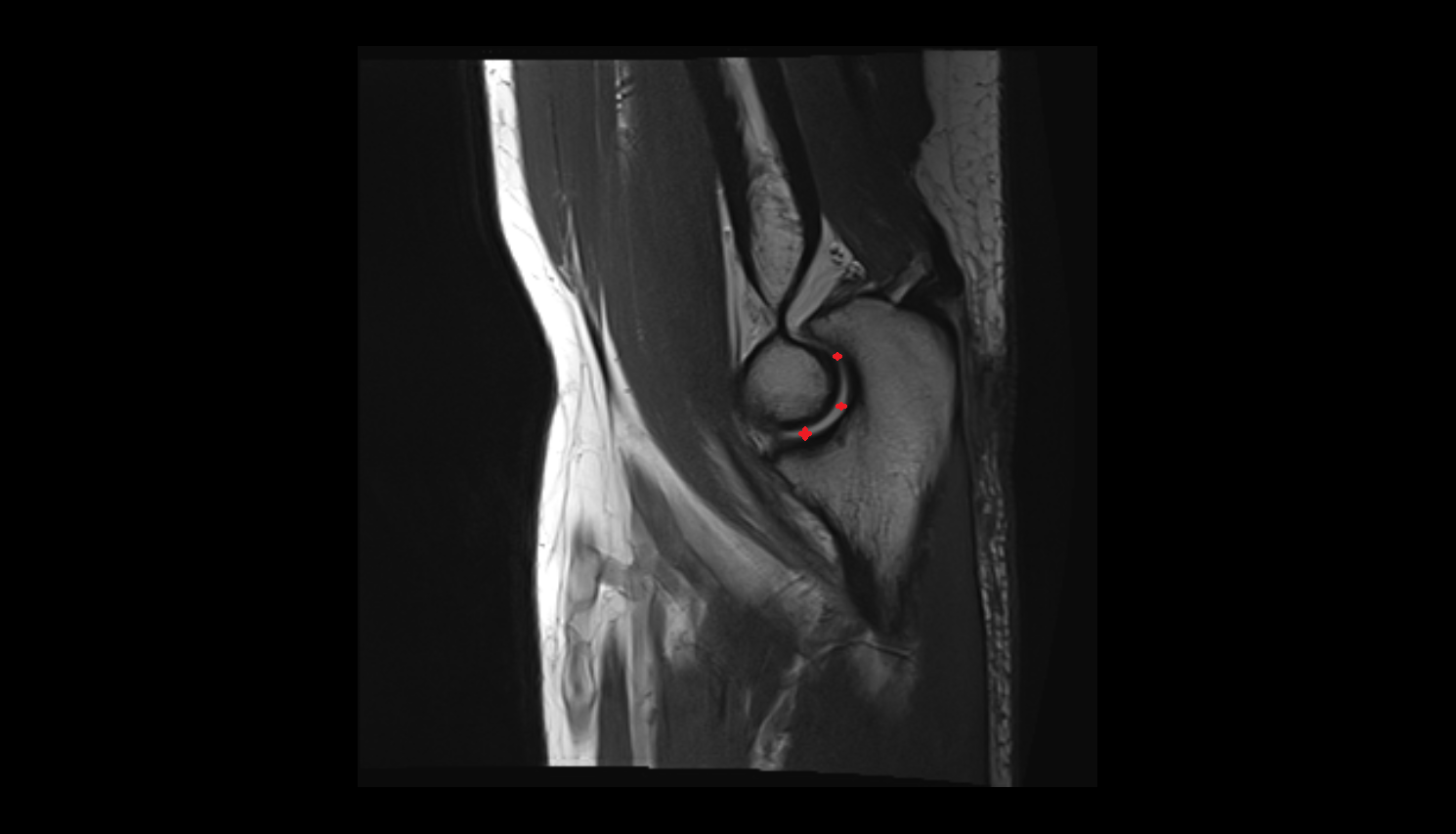 Humeroulnar joint sag  cross sectional anatomy 3T MRI AI enhanced radiology image -img-00000-00000