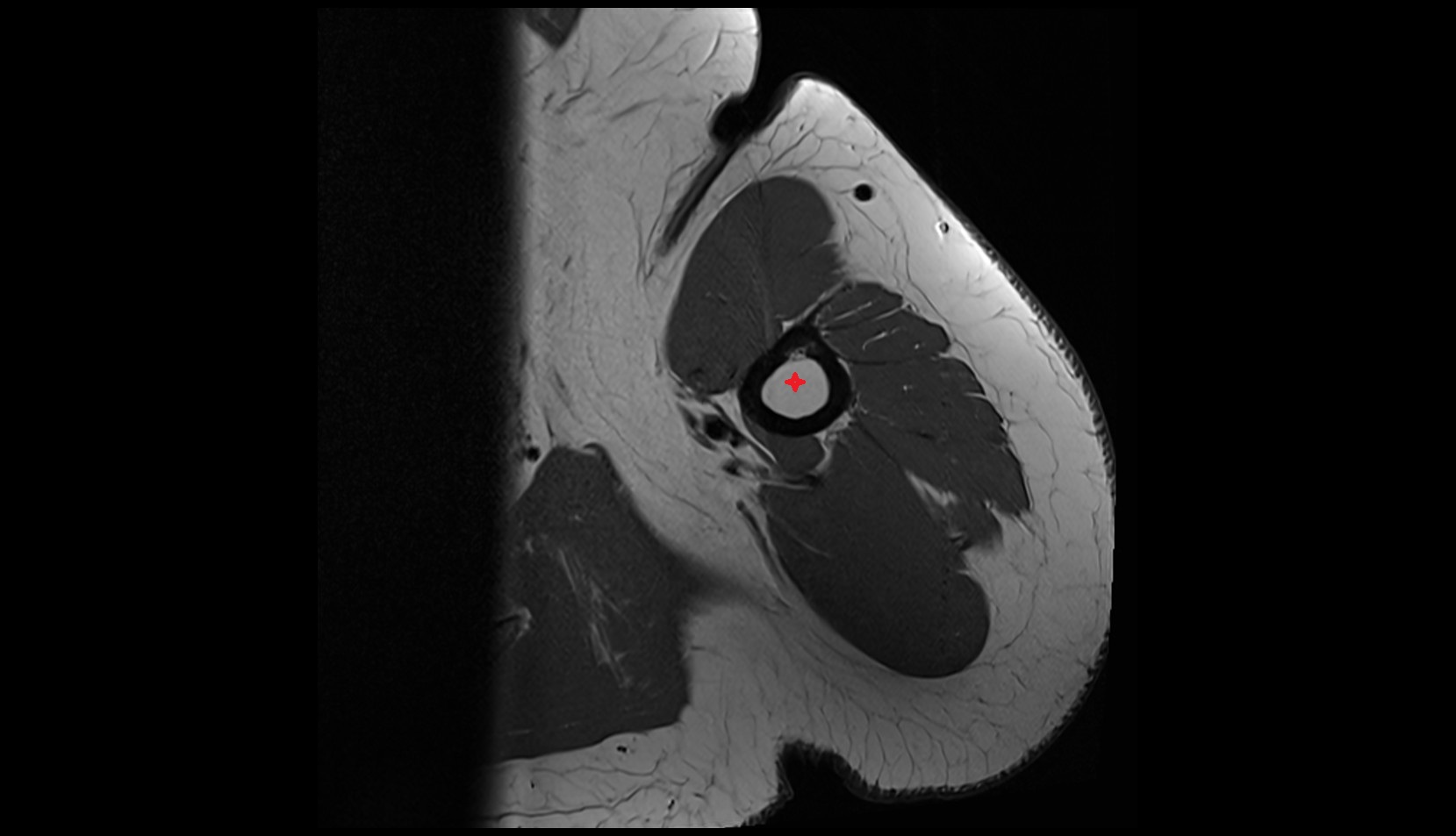 Humerus MRI axial anatomy image