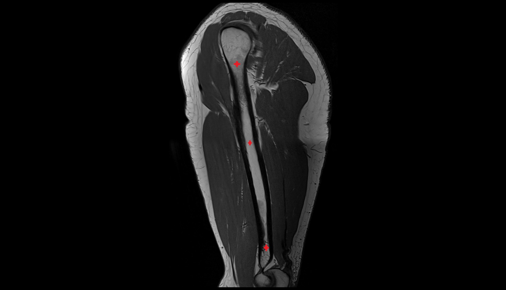 Humerus MRI sagittal anatomy image