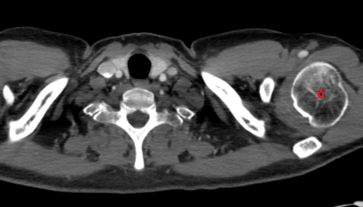 Humerus anatomy CT axial  image -img-00000-00000
