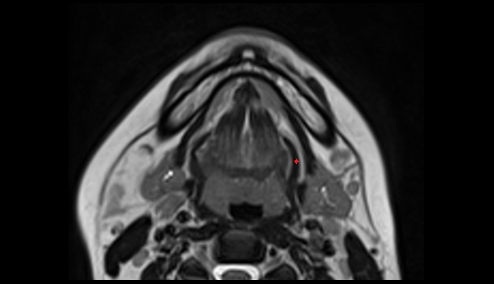Hyoglossus muscle MRI AXIAL IMAGE