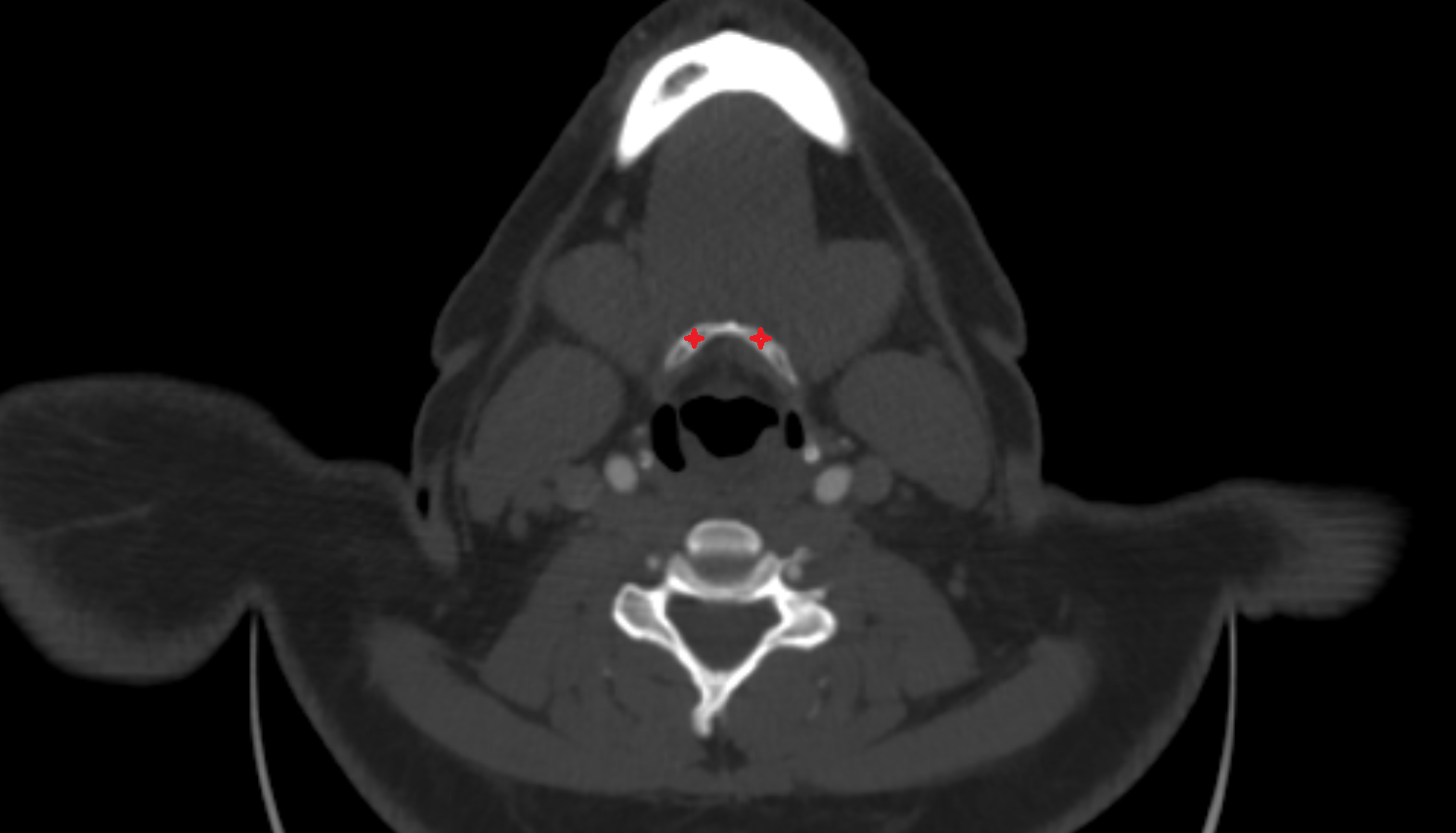 Hyoid bone anatomy  Location and Imaging Appearance  -img-00000-00000