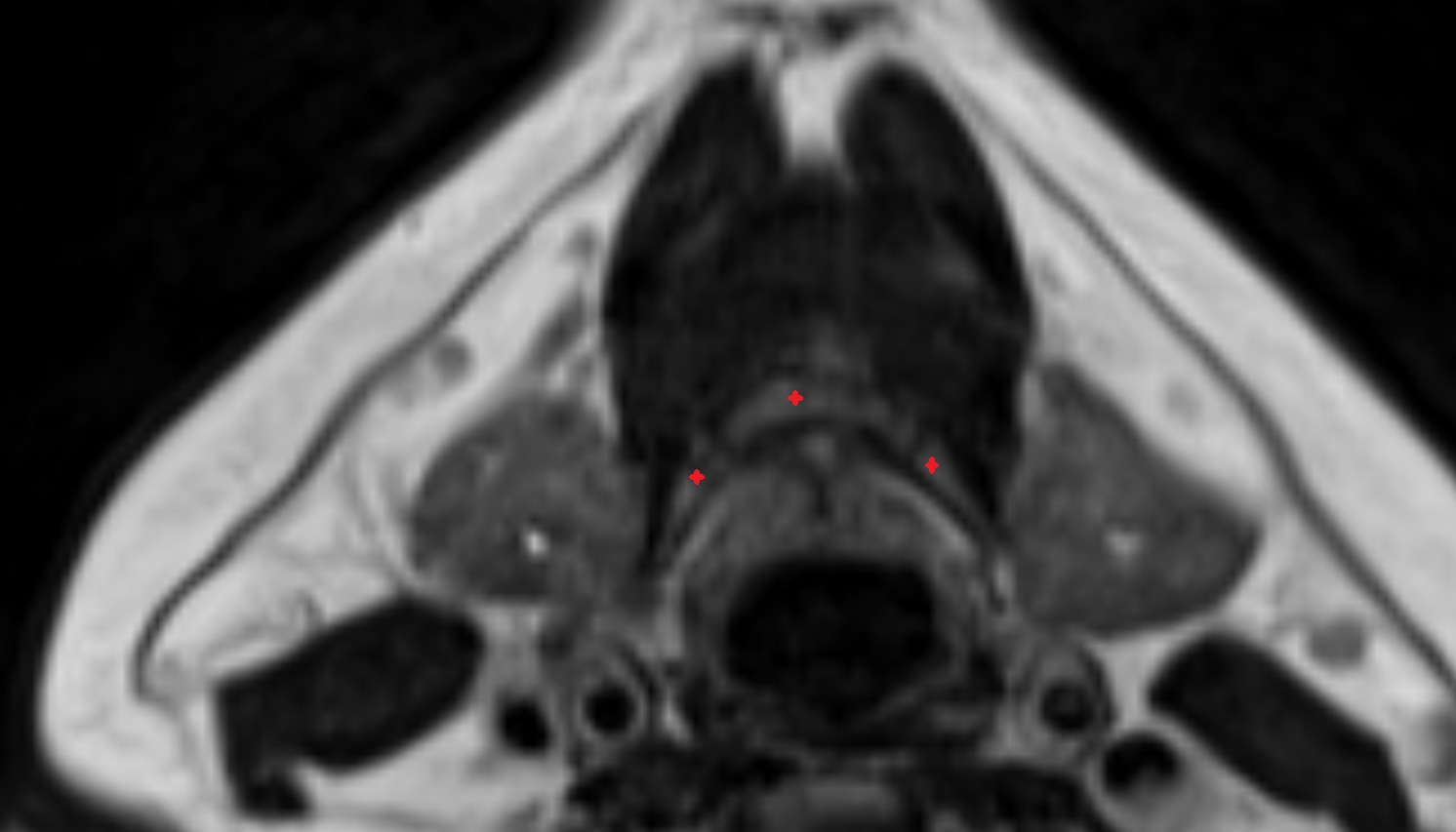 Hyoid bone  mri axial  image -img-00000-00000