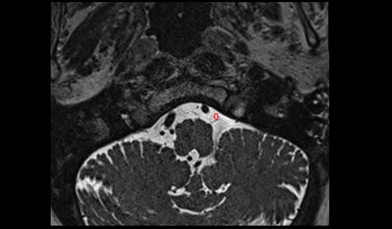 Hypoglossal nerve (Cranial nerve XII) 3T MRI axial image