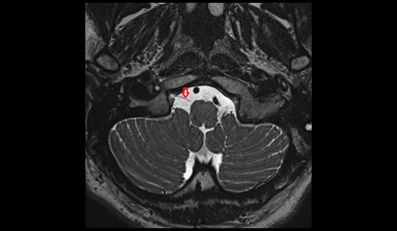 Hypoglossal nerve (Cranial nerve XII) 3T MRI axial image 1