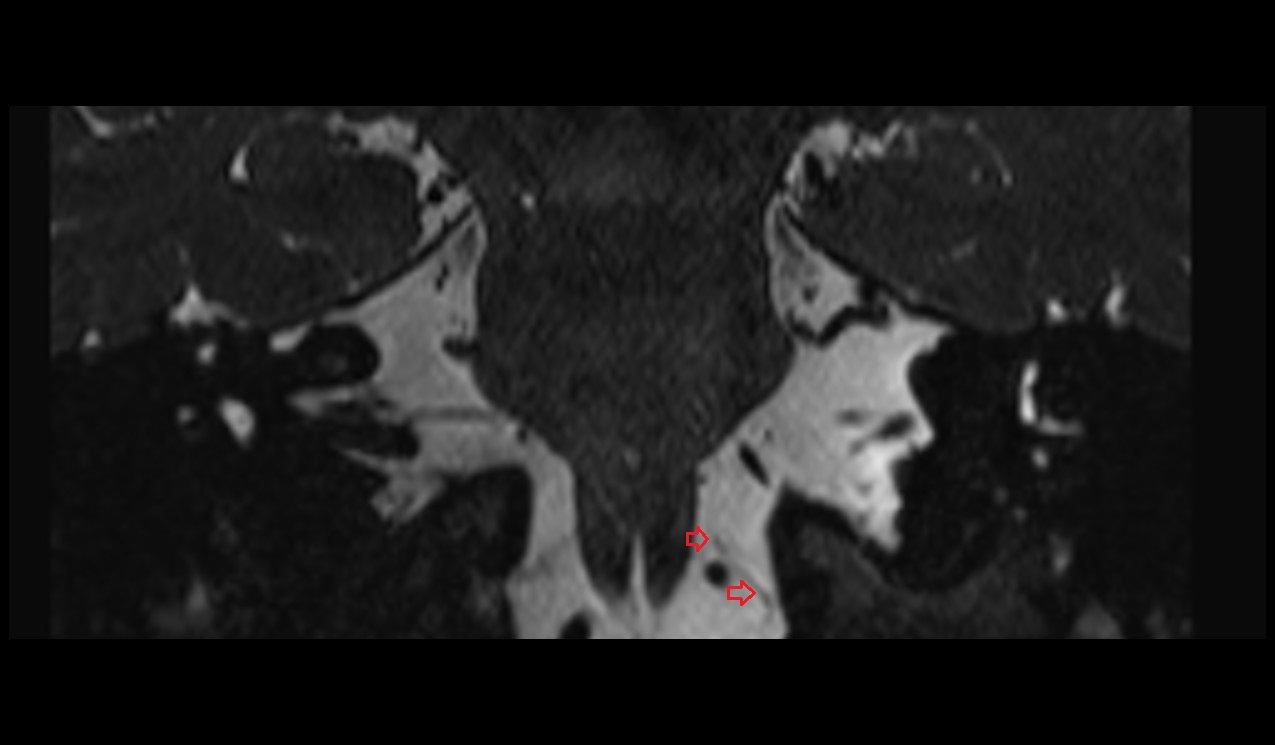 Hypoglossal nerve (Cranial nerve XII) 3T MRI coronal image